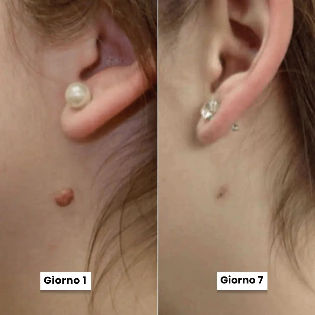 DermaSkin Pro - Addio ai porri della pelle