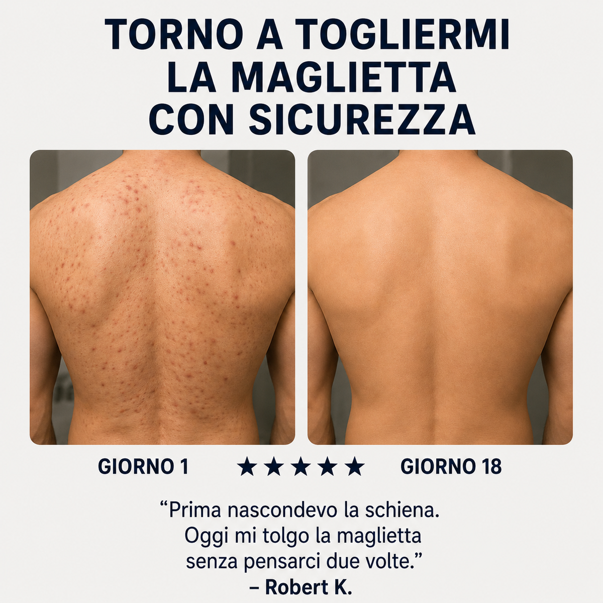 Sapone Zanari per la schiena contro l’acne