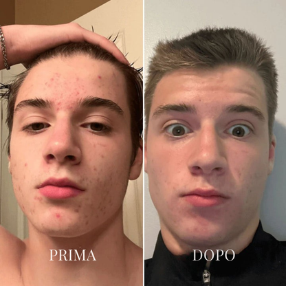Aspiratore viso innovativo per la cura della pelle