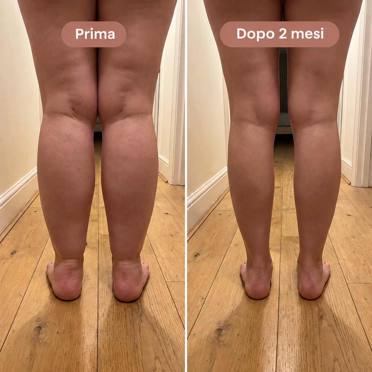 Elovya leggings lipedema compressione 4D